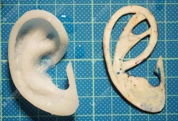 广州高尚余文林做的人工骨舒铂耳支架图片