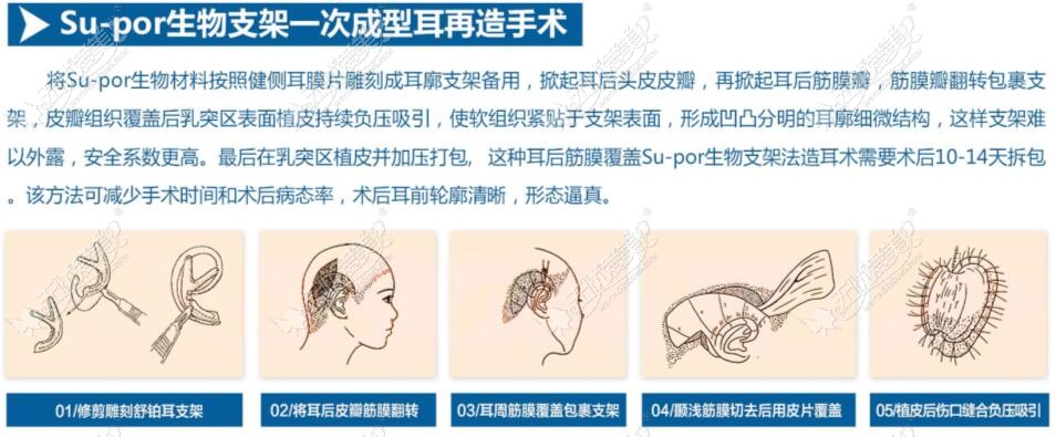 人工骨舒铂耳再造手术过程图片