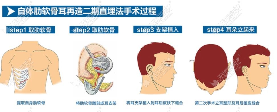 自体肋骨再造耳手术过程图解