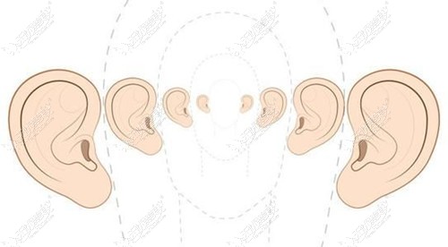 小耳再造全包和直埋法哪个好?从二者的手术优缺点做对比