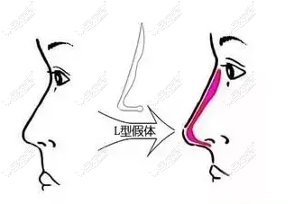 假体隆鼻修复前后对比图