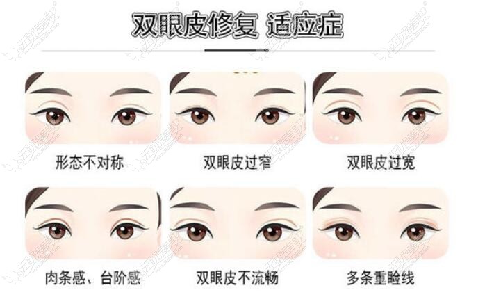 广州李光琴做的双眼皮修复常见症状