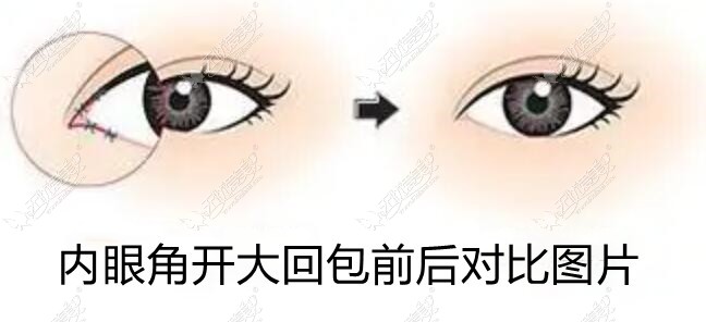 大连刘志刚内眼角修复实例:内眼角开大成功回缩,价位48000多
