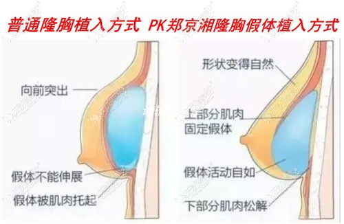 长沙亚韩隆胸靠谱