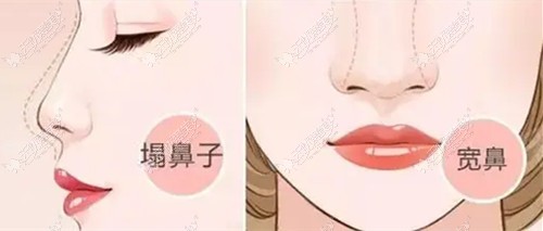 武汉付俊俐隆鼻技术挺好,从她近期做的鼻子实例就能看出来