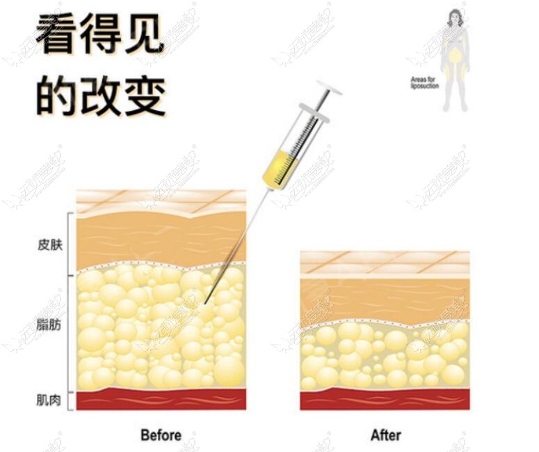 吸脂变化对比图