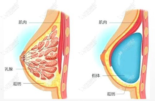 黄广香隆胸手术技术优势