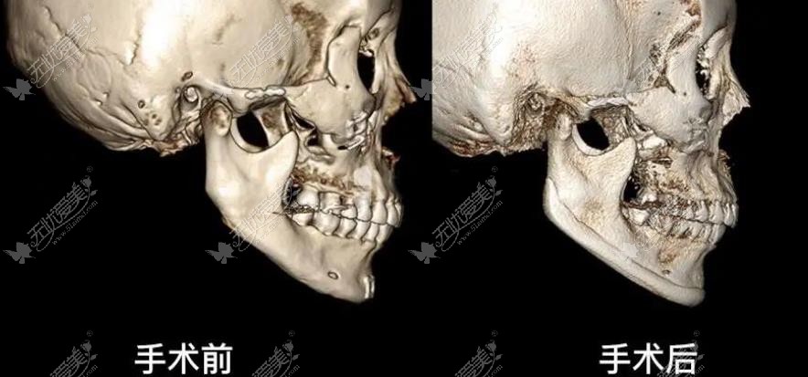下颌角peek修复前后对比图