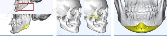 peek修复下颌角手术前后对比图m.51aimei.com