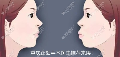 重庆正颌手术推荐医生:王涛/肖林做正颌好,有真实例子证实
