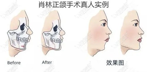 肖林正颌手术实例