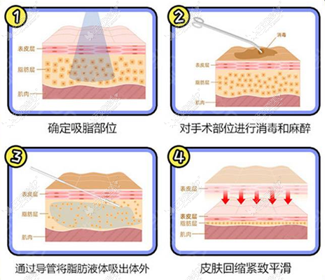 www.51aimei.com提供的美贝尔快乐吸脂技术图