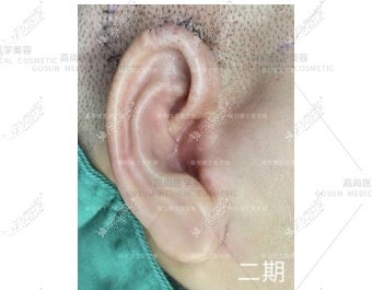 余文林医生做的肋软骨耳再造图片