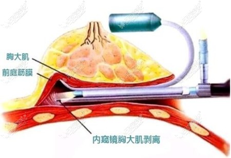 李湘原假体隆胸技术
