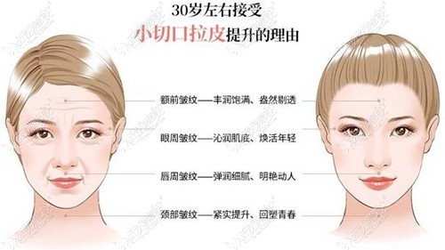 www.51aimei.com提供的青岛华颜美做拉皮手术适合人群