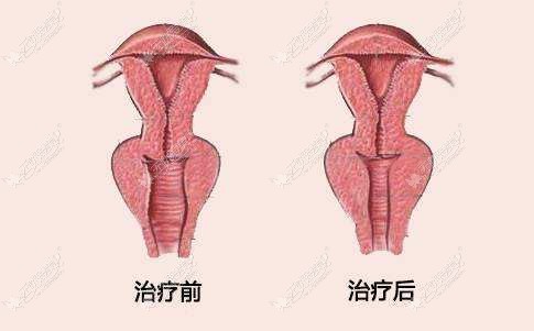 韩国丽姿医院激光缩阴手术前后对比图片
