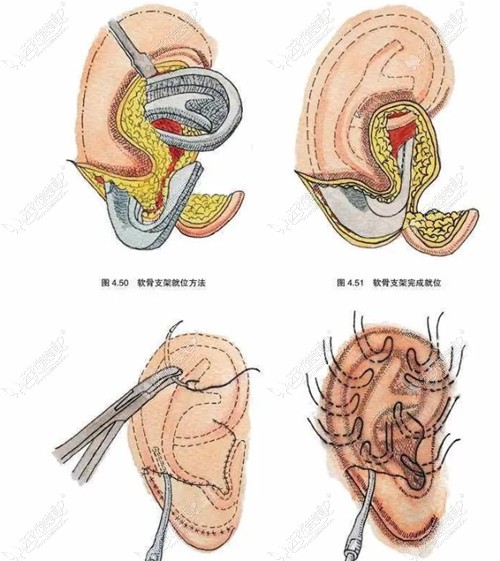 耳再造手术过程