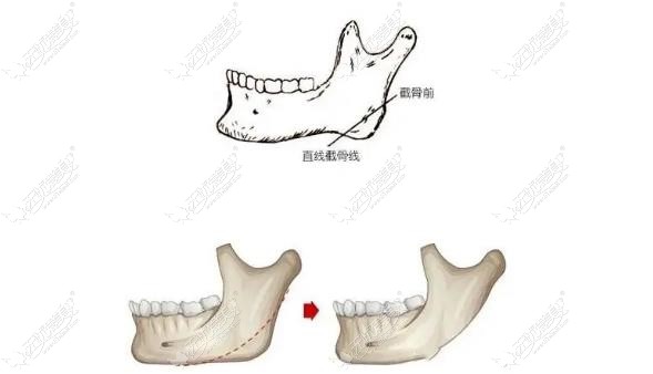 下颌角补骨修复实例图