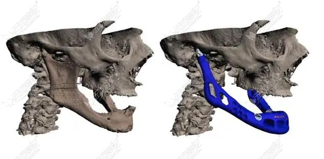 3D打印人工骨修复下颌角技术图