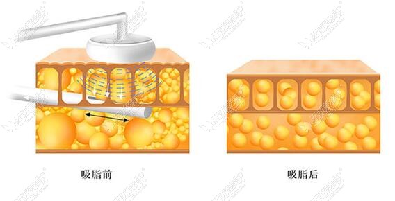 www.51aimei.com通过的福州美贝尔吸脂技术图