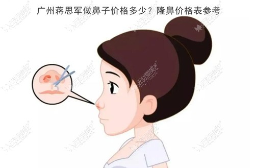 广州蒋思军做鼻子价格多少,肋骨鼻综合/歪鼻修复费用1万起