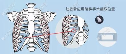 www.51aimei.com提供的蒋思军肋骨鼻综合技术图