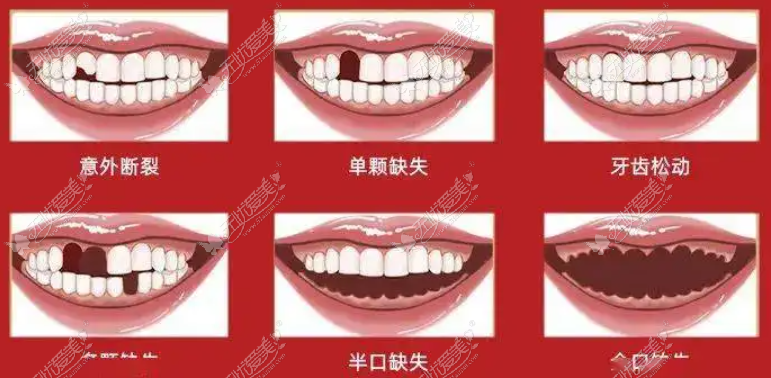 牙齿缺失的不同类型
