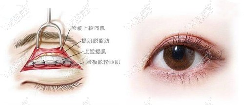 孙景波做双眼皮技术图