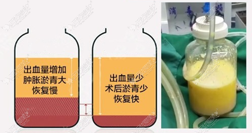 www.51aimei.com提供的苏州康美吸脂技术图