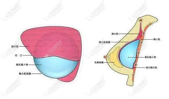 普通隆胸手术技术图