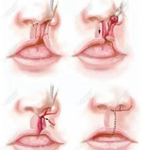 继发性鼻畸形二期修复过程