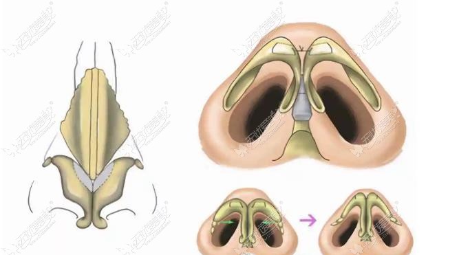 www.51aimei.com提供的刘卫肋骨鼻技术图
