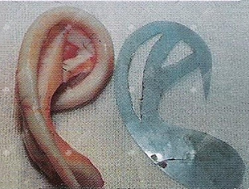 小耳畸形矫正手术雕刻的软骨图