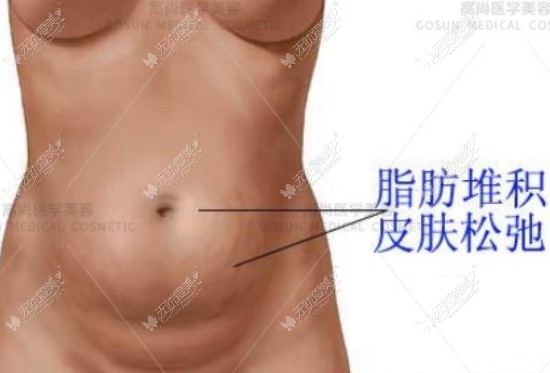 广州腹壁整形医院排名前十,腹部拉皮好且便宜选前三准没错
