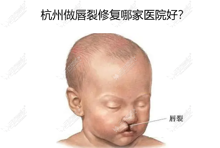 杭州唇裂修复好的医院:杭州维多利亚修复成人,儿童唇裂厉害