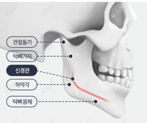 韩国TS整形医院李相均院长做下颌角磨骨技术特色