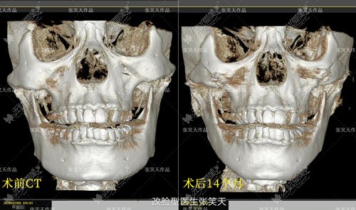 张笑天下颌角磨骨示例前后对比图