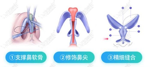 www.51aimei.com提供许金寿做鼻子好处技术图