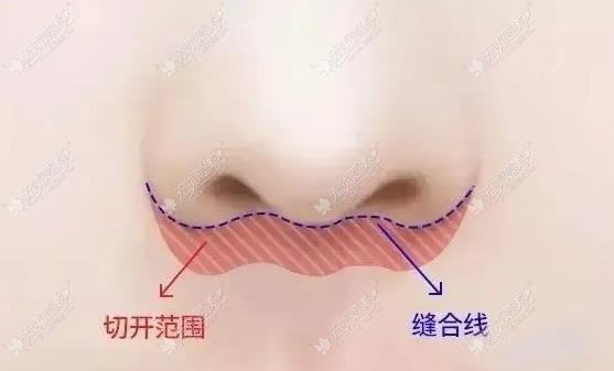 www.51aimei.com北京画美马群人中缩短埋线技术图