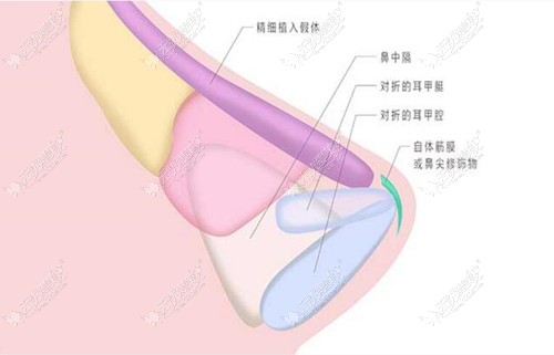 www.51aimei.com刘彦斌隆鼻技术图