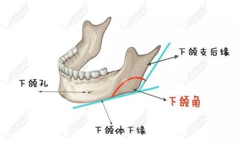 广东韩妃整形下颌角截骨手术技术图