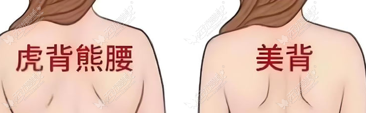 无锡施尔美医疗美容医院的刘祥医生吸脂 3.0 无锡施尔美医疗美容医院的刘祥医生吸脂 3.0