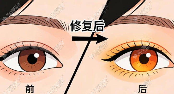 钟豪医生做双眼皮的热门问答(Q&A) 钟豪医生做双眼皮的热门问答(Q&A)