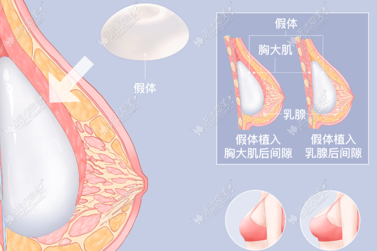 隆胸手术